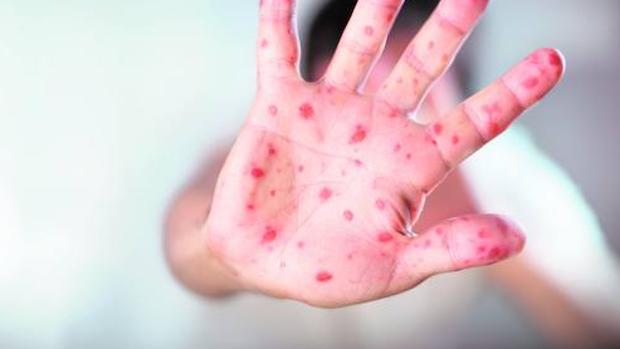 Sarampión: intensifican la vigilancia epidemiológica de la enfermedad