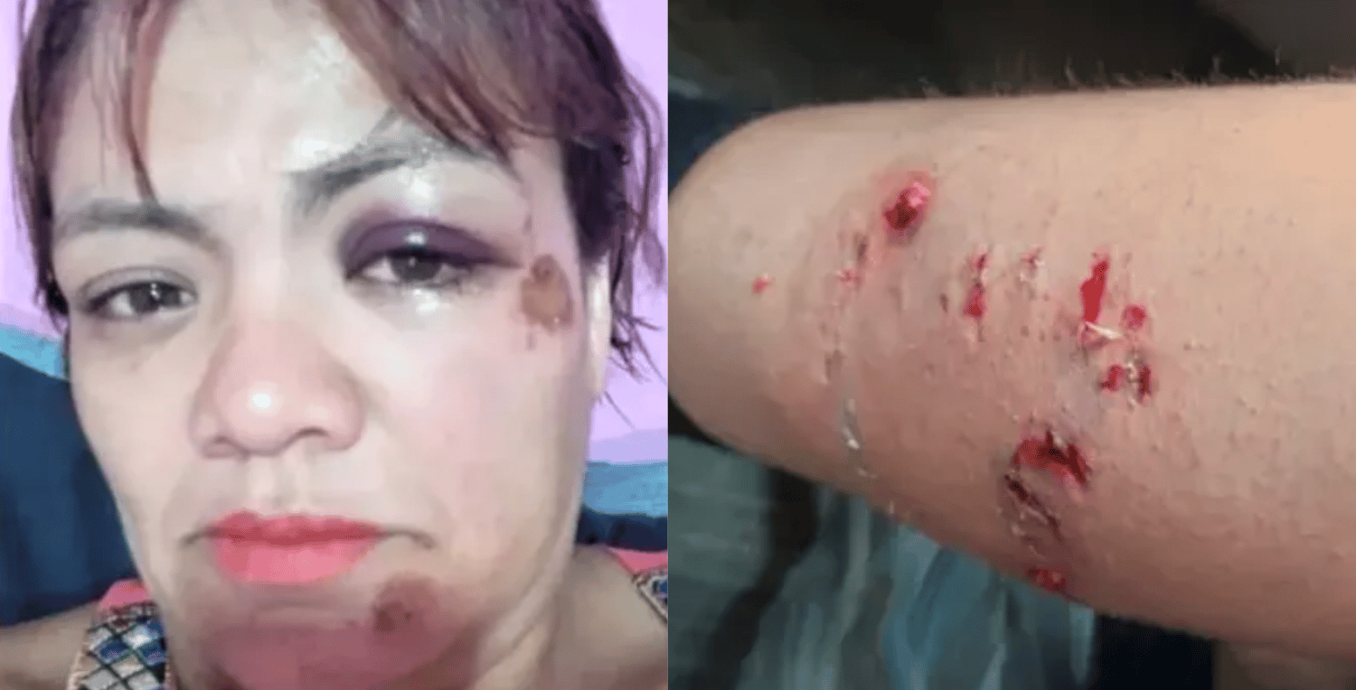 Villa La Angostura: una mujer fue brutalmente atacada por una jauría de perros cuando paseaba en bicicleta