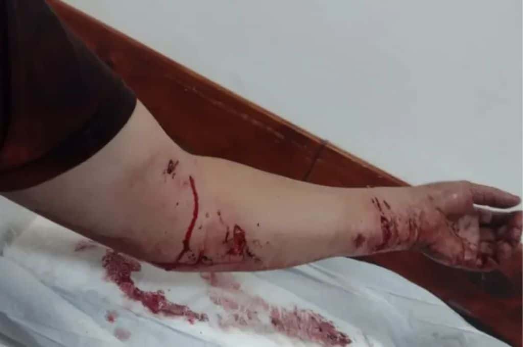 Ataque de pitbulls en Neuquén: una joven embarazada y su pareja resultaron heridos